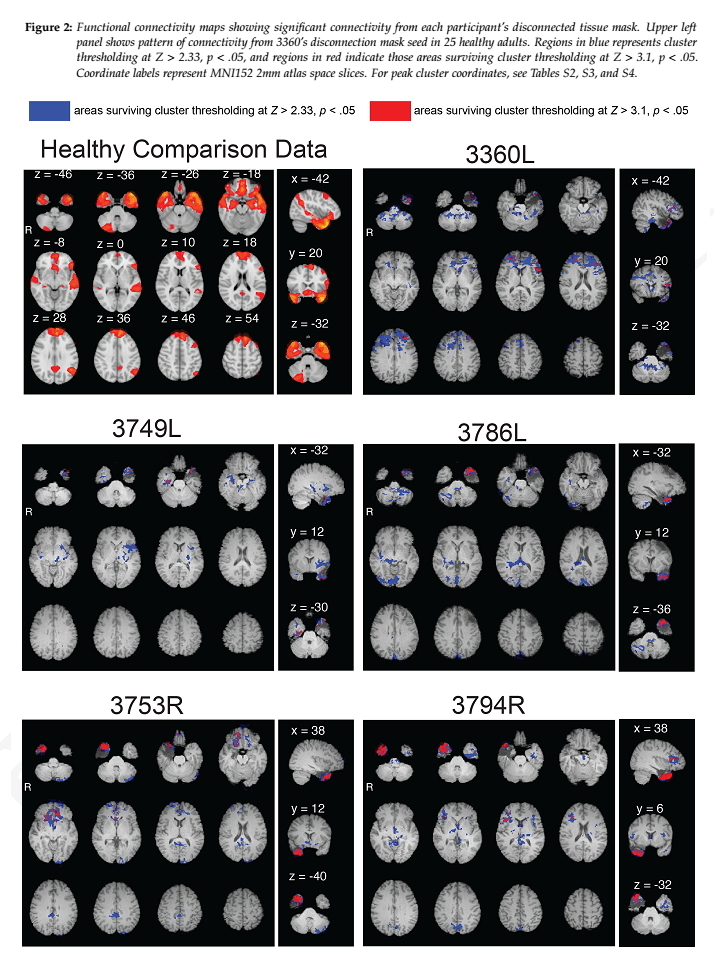 Functional Connectivity Between Surgically Disconnected Brain Regions?