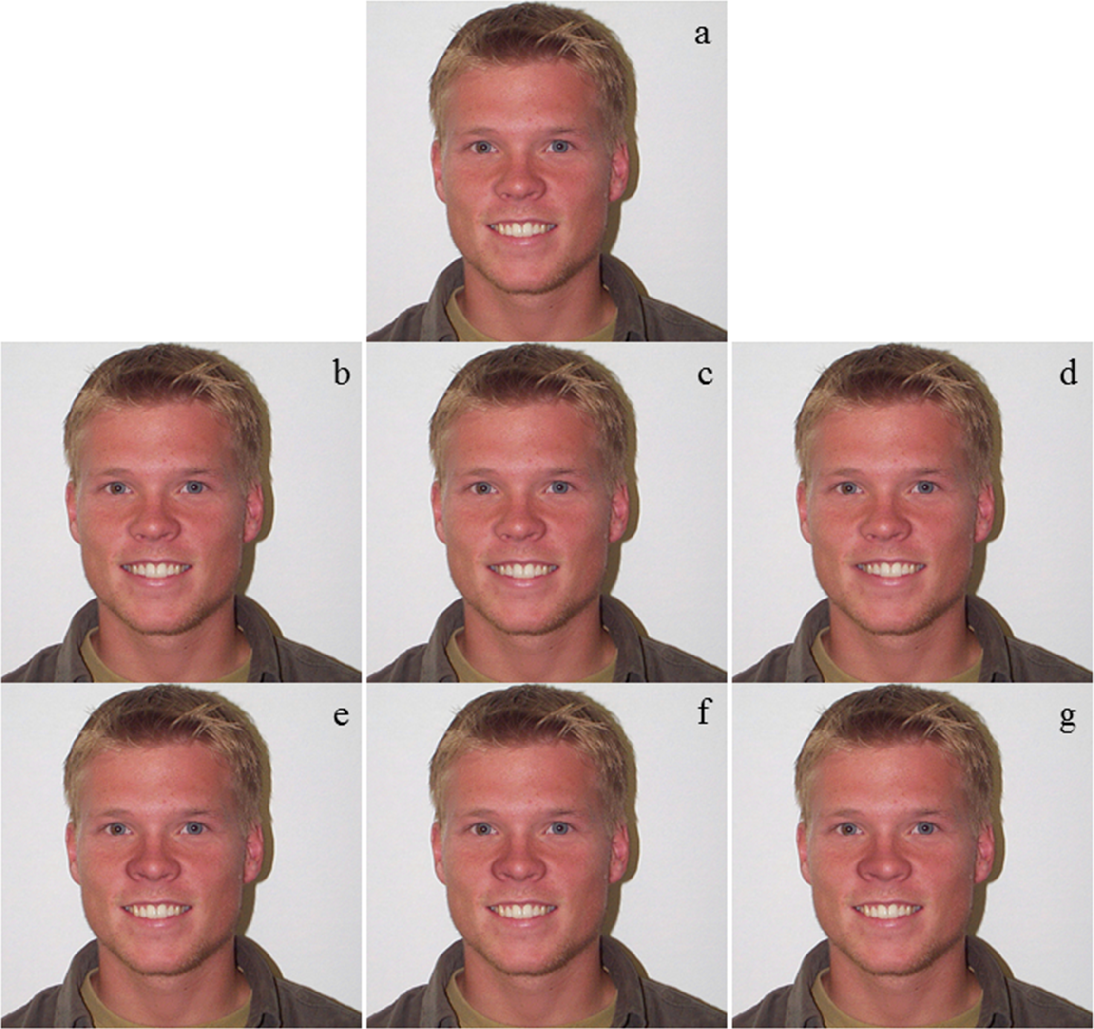 Figure 1: A set of pictures used for attractiveness evaluation. One set of pictures, in which the right side of the nose and the mouth were used to make the trait symmetric (A) unmanipulated face (B) right symmetric, centered mouth (C) right symmetric mouth, skewed 0.5 cm to the right (D) right symmetric mouth, skewed 1.0 cm to the right (E) right symmetric, centered nose (F) right symmetric nose, nose tip skewed 0.5 cm to the right (G) right symmetric nose, nose tip skewed 1.0 cm to the right.