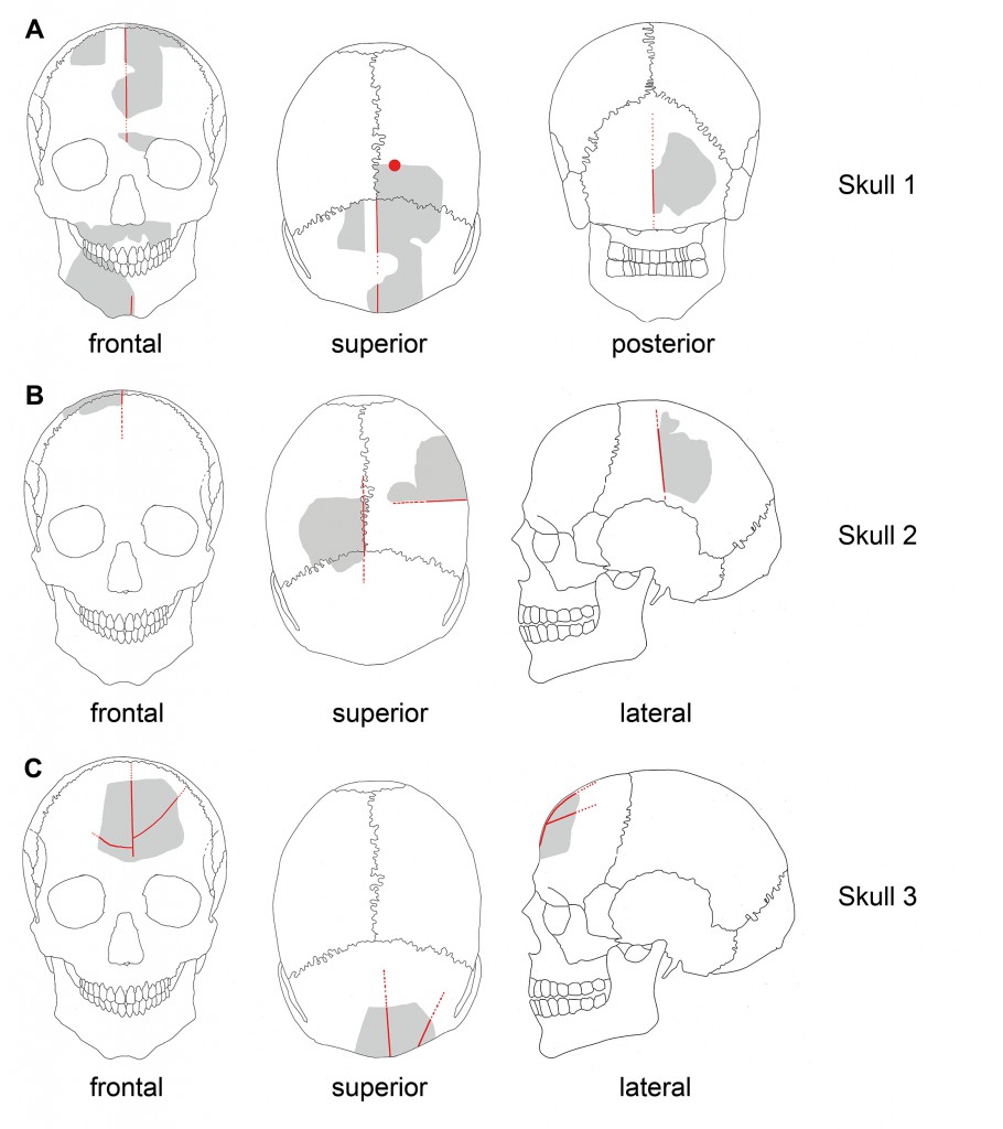 Shaded portions represent the pieces of each skull recovered at Göbekli Tepe; red lines indicate where the deep grooves were made. The drilled hole in Skull 1. (Credit Julia Gresky, Juliane Haelm, DAI)