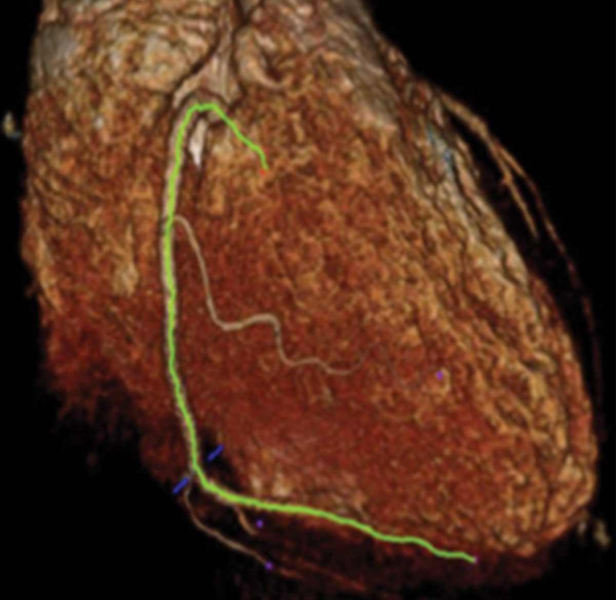 New, Noninvasive Imaging Technique Finds Heart Disease Before It Hurts