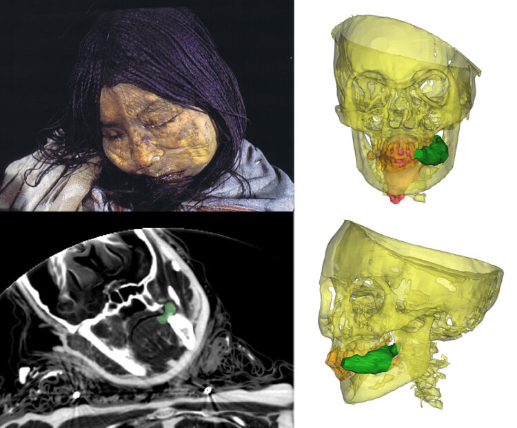 This frozen mummy was found entombed near the top of the Llullaillaco volcano in northwest Argentina. Known as the Llullaillaco Maiden, the 13-year-old was ritually killed in an Inca rite hundreds of years ago. An X-ray image reveals a wad of coca leaves (colored green) clenched between her teeth. (Credit: REDIT: A.S. WILSON ET AL / PNAS 2013 (PHOTOS: JOHAN REINHARD; CT SCANS: DEPT OF FORENSIC MEDICINE/UNIV. OF COPENHAGEN)