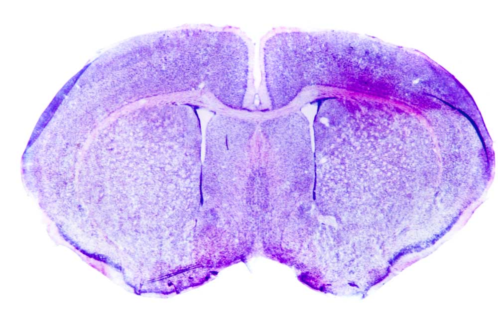 Using Ultrasound, Scientists Deliver Drugs To Specific Brain Regions